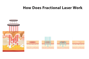 NUBWAY | What is Fractional CO2 Laser Machine?