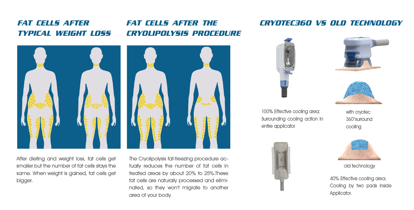 NUBWAY | Does Fat Freezing can really be effective to reduce the weight?