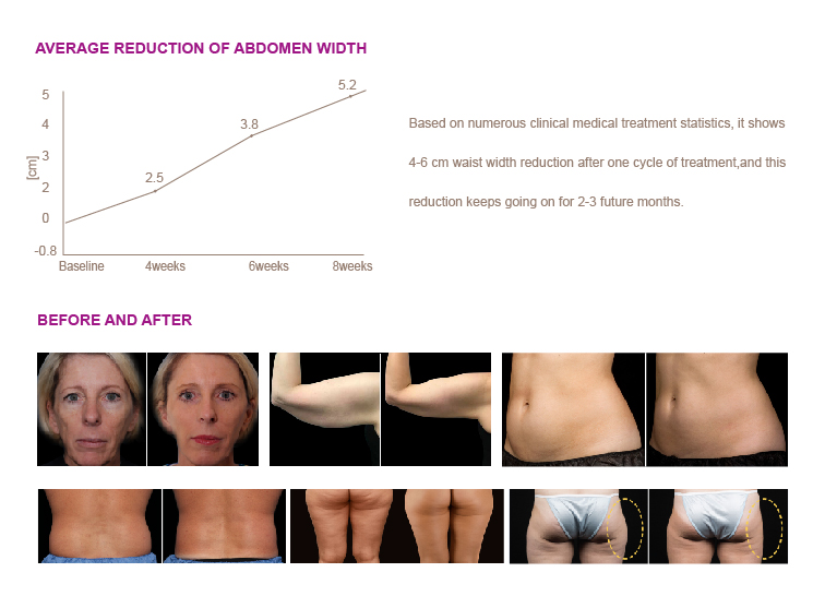 NUBWAY | How long does it take to see the results of VelaShape?