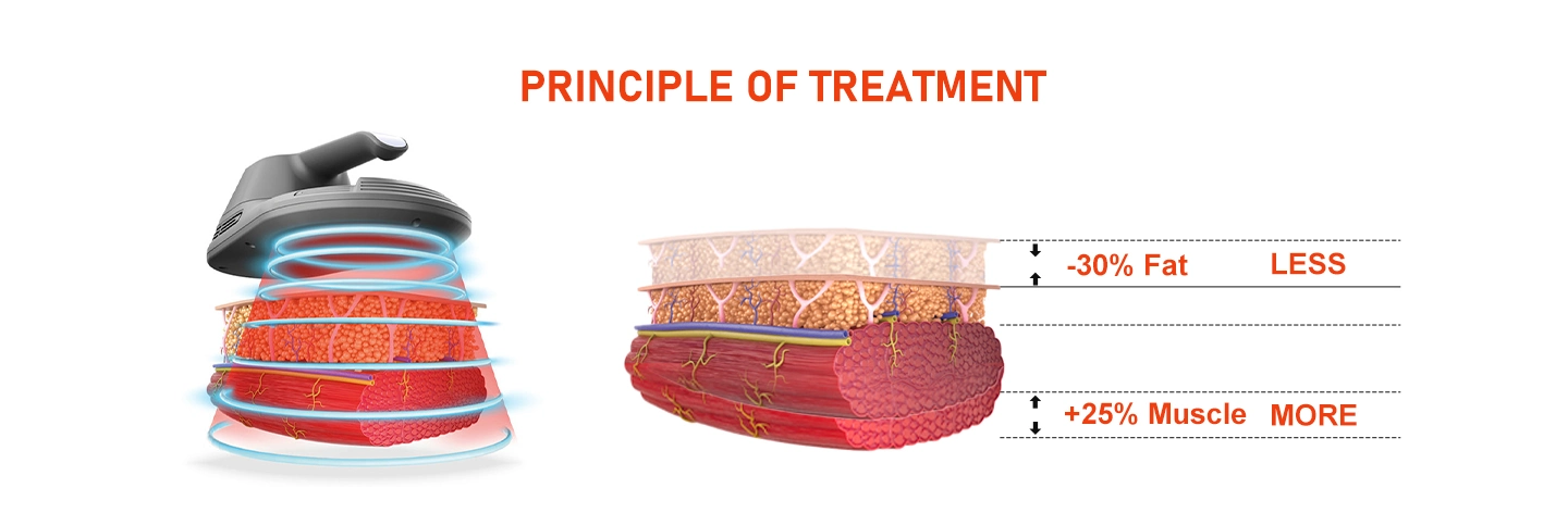 NUBWAY | Unlocking the Potential of RF+EMS Sculpting for Your Body