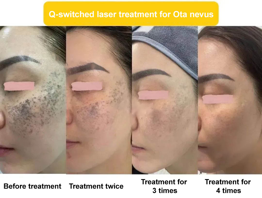 NUBWAY | Diagnosis and treatment of Ota nevus