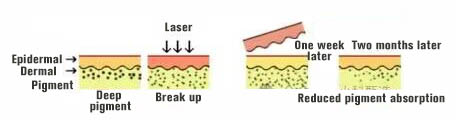 NUBWAY | Does laser freckle removal take effect in one month? Will it need three months to take effect?