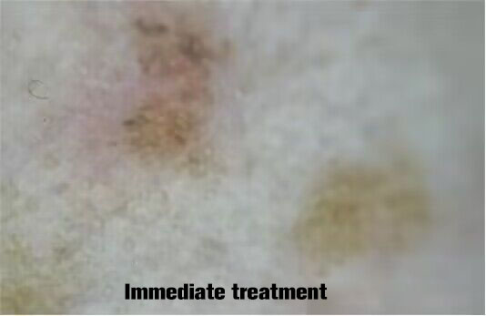 NUBWAY | Freckle removing! The importance of treatment evaluation