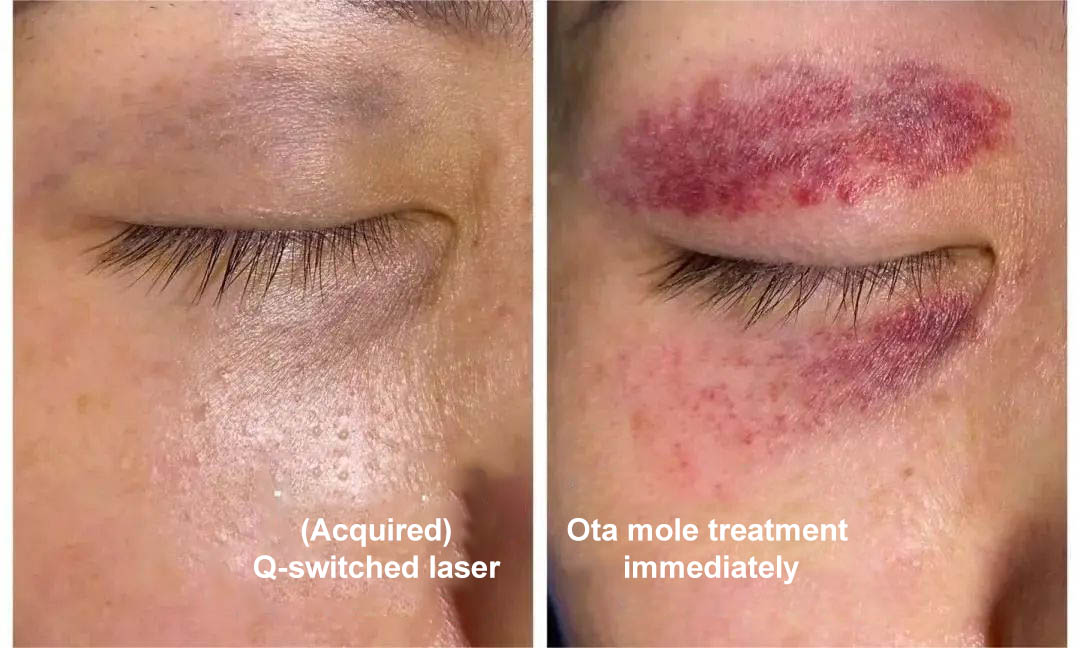 NUBWAY | Diagnosis and treatment of Ota nevus