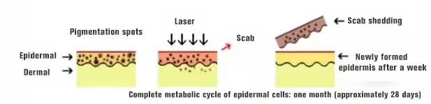 NUBWAY | Does laser freckle removal take effect in one month? Will it need three months to take effect?