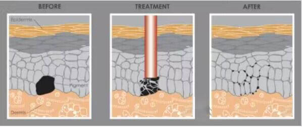 NUBWAY | Does laser freckle removal take effect in one month? Will it need three months to take effect?