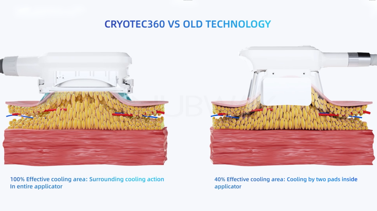 NUBWAY | Fat Freezing Unveiled: Evidence-Based Analysis of Cryolipolysis Effectiveness