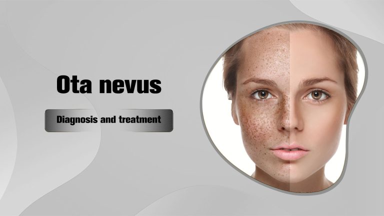 Diagnosis and treatment of Ota nevus