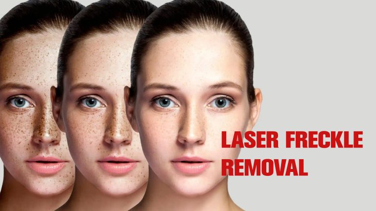 lser freckle removal