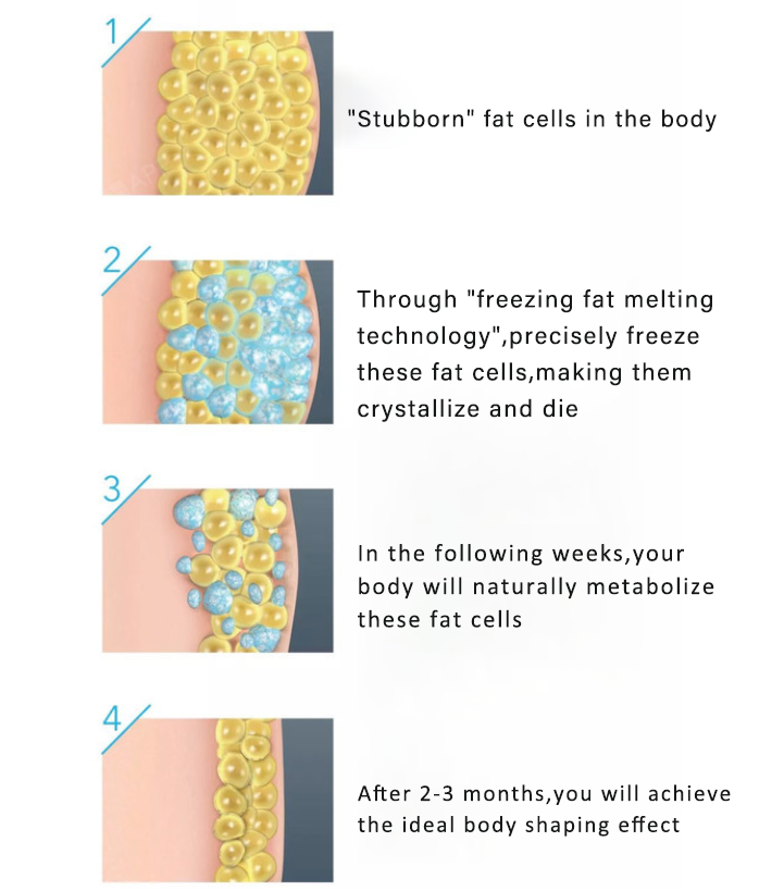 NUBWAY | Three major methods of medical beauty lipolysis