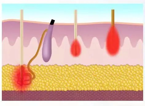 NUBWAY | Is microneedling better at home or professional？